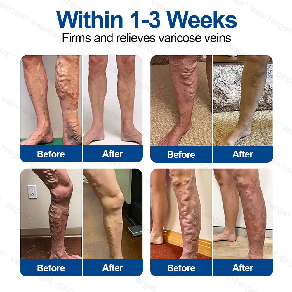 🇬🇧❤️🦵✅GFOUK® EKlinisk Microneedle Patch (with Diosmin & Hesperidin) is an advanced plant-based formulation specially developed to target spider veins and varicose veins, while also helping to relieve the feeling of heavy and tired legs.-K2