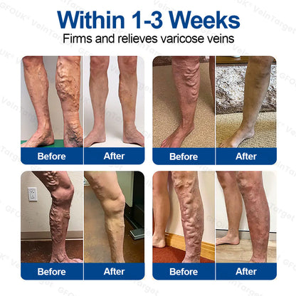 🇬🇧❤️🦵✅GFOUK® EKlinisk Microneedle Patch (with Diosmin & Hesperidin) is an advanced plant-based formulation specially developed to target spider veins and varicose veins, while also helping to relieve the feeling of heavy and tired legs.-K2