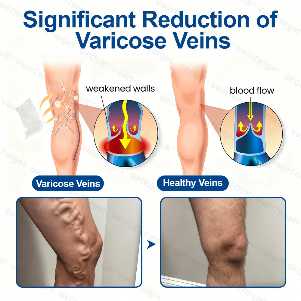 🇬🇧❤️🦵✅GFOUK® EKlinisk Microneedle Patch (with Diosmin & Hesperidin) is an advanced plant-based formulation specially developed to target spider veins and varicose veins, while also helping to relieve the feeling of heavy and tired legs.-K2